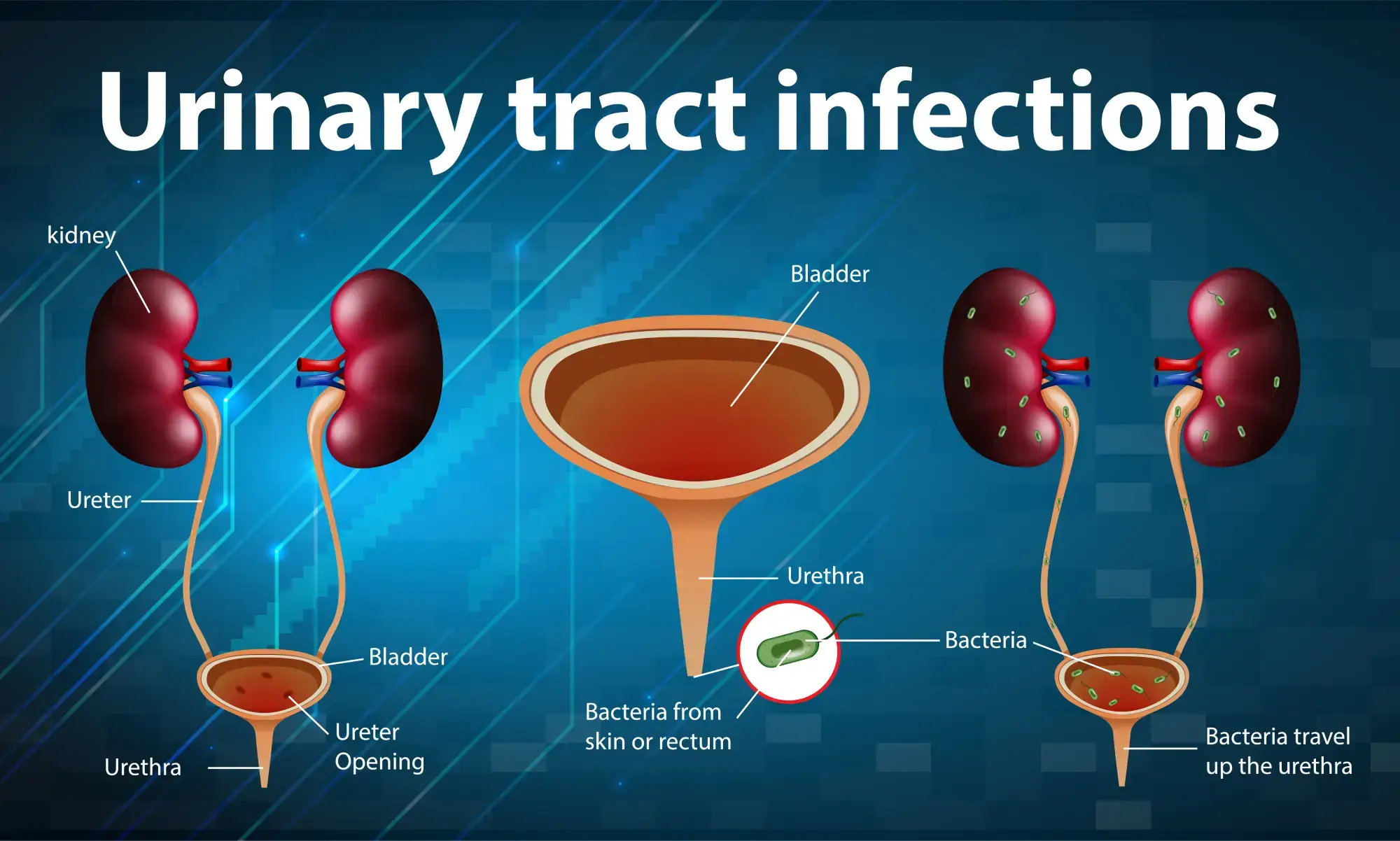 Urinary Tract Infection Specialist in Chennai